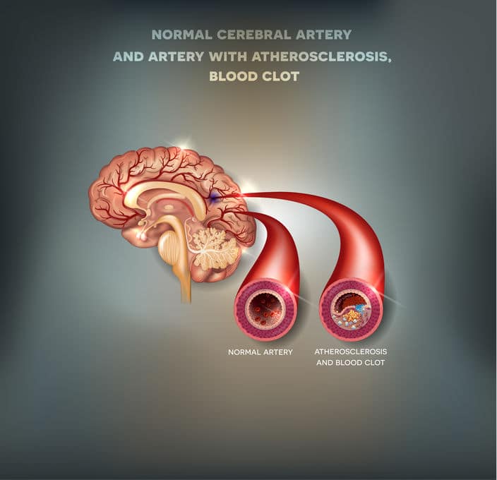 cerebrovascular-accident-cva